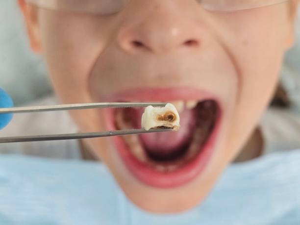 Best Emergency Tooth Extraction  in Eagan, MN